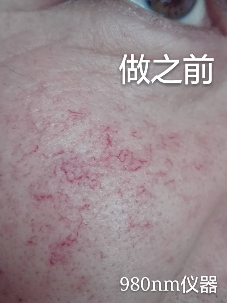 Professional Beauty Machine 980nm Diode Laser Vascular Removal /High Frequency Spider Vein Removal Machine