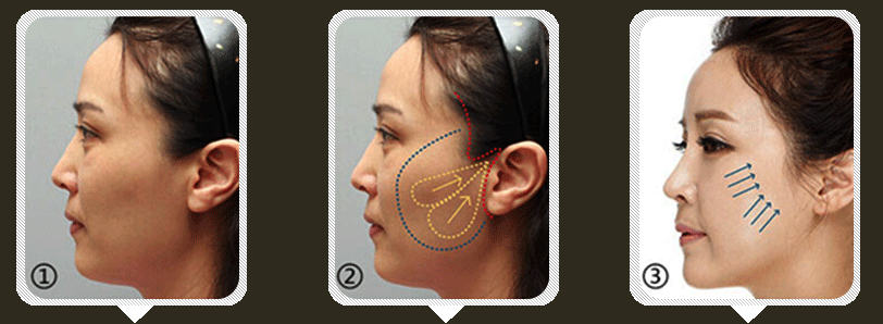 Hifu For Face Lifting And Slimming Machine