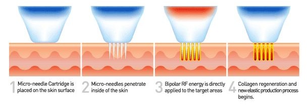 Portable Machine Fractional RF Microneedle Machine