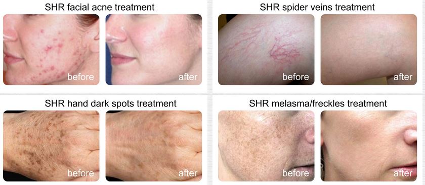 IPL hair Removal Machine IPL hair Removal Machine