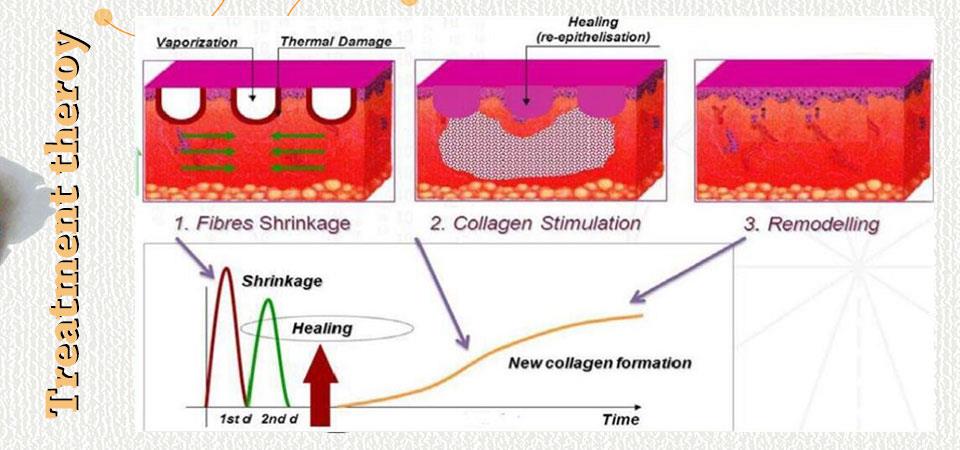 Co2 Laser Skin And Face Lifting