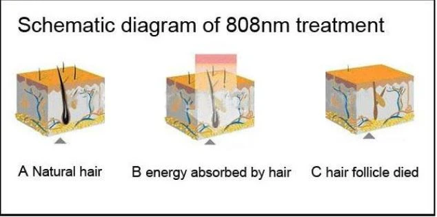 Professional 808nm Laser Hair Removal Machine For Sale