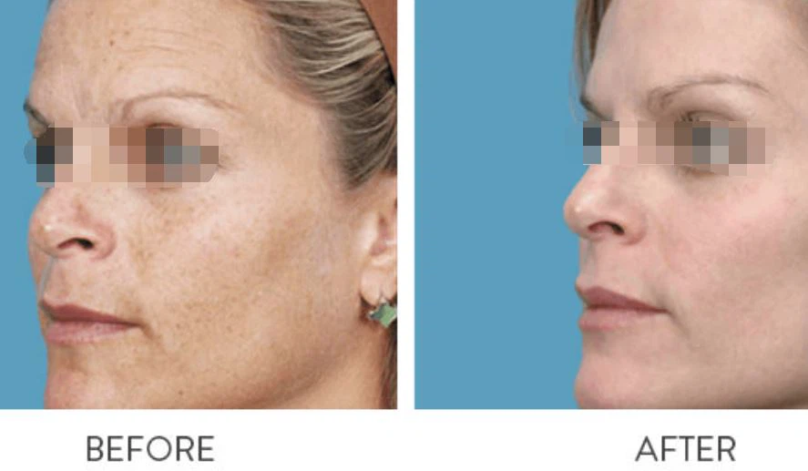 IPL skin rejuvenation