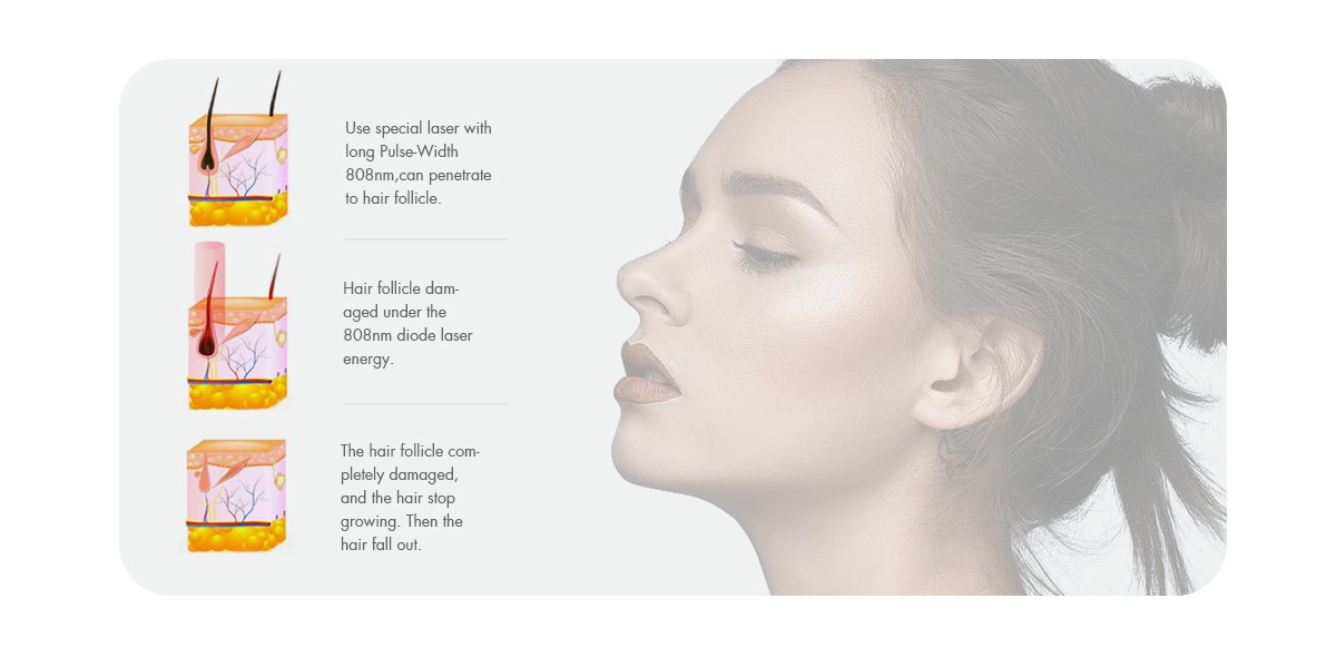 3000W Exchangeable Spot Size 808nm Diode Laser Hair Removal